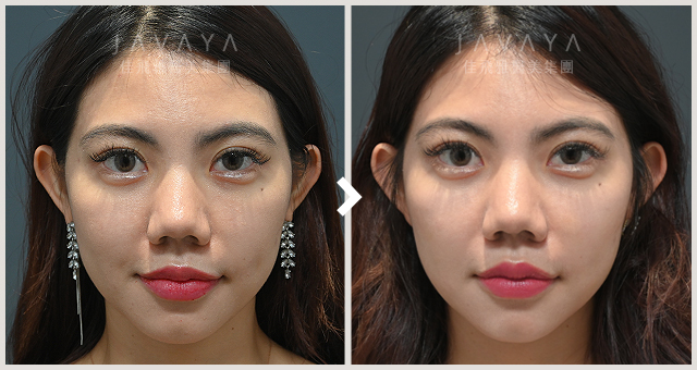 肉毒注射咀嚼肌｜見證案例_07